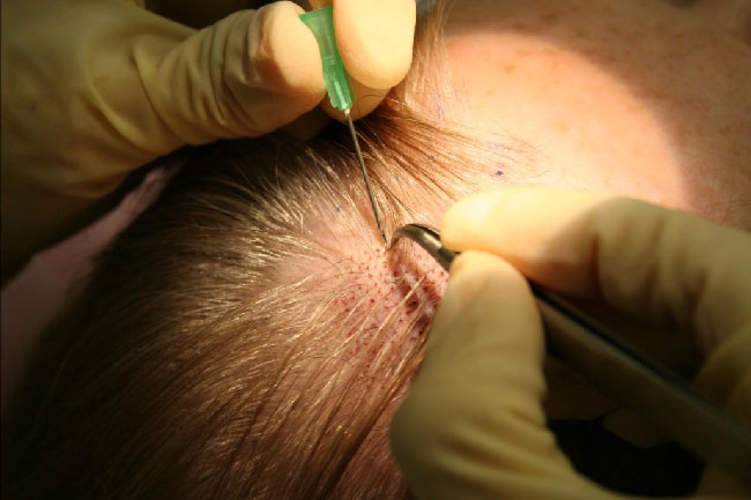 احذر اضرار زراعة الشعر