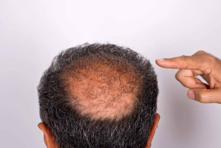 كل ما تريد أن تعرفه عن زراعة الشعر