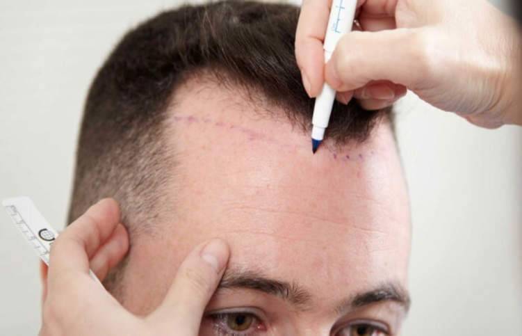 كل ما عليك معرفته قبل وبعد عملية زراعة الشعر