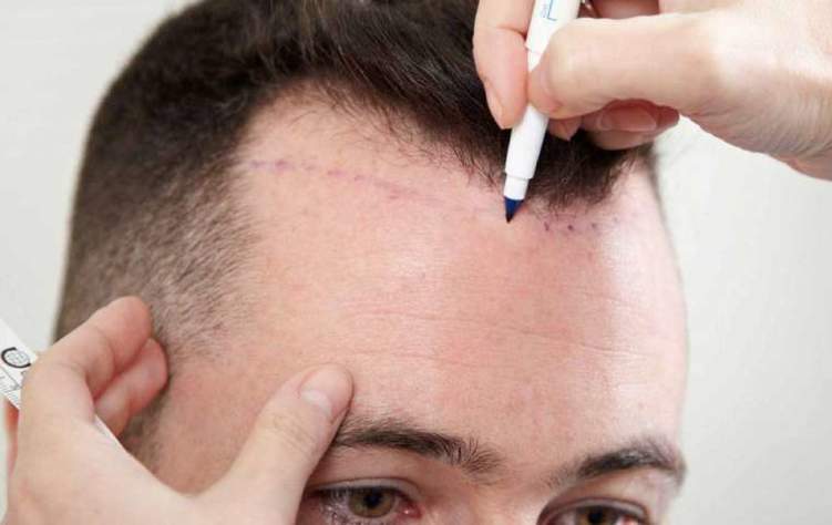 ما هي بدائل عملية زراعة الشعر؟!