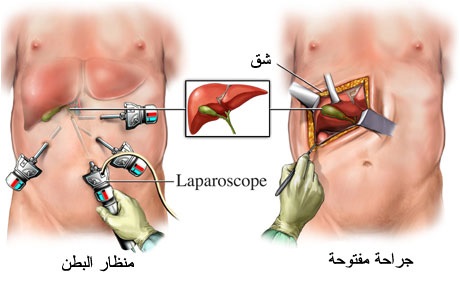 اعراض المرارة